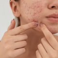 Acne Prone