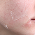 Dry Skin