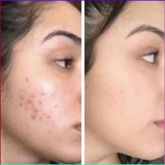 AntiAcne Bundle
