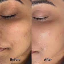 Anti Darkspots Bundle